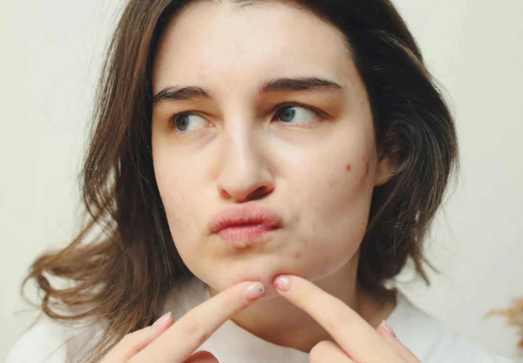 Crescimento de acne entre mulheres acende alerta para impactos na saúde emocional