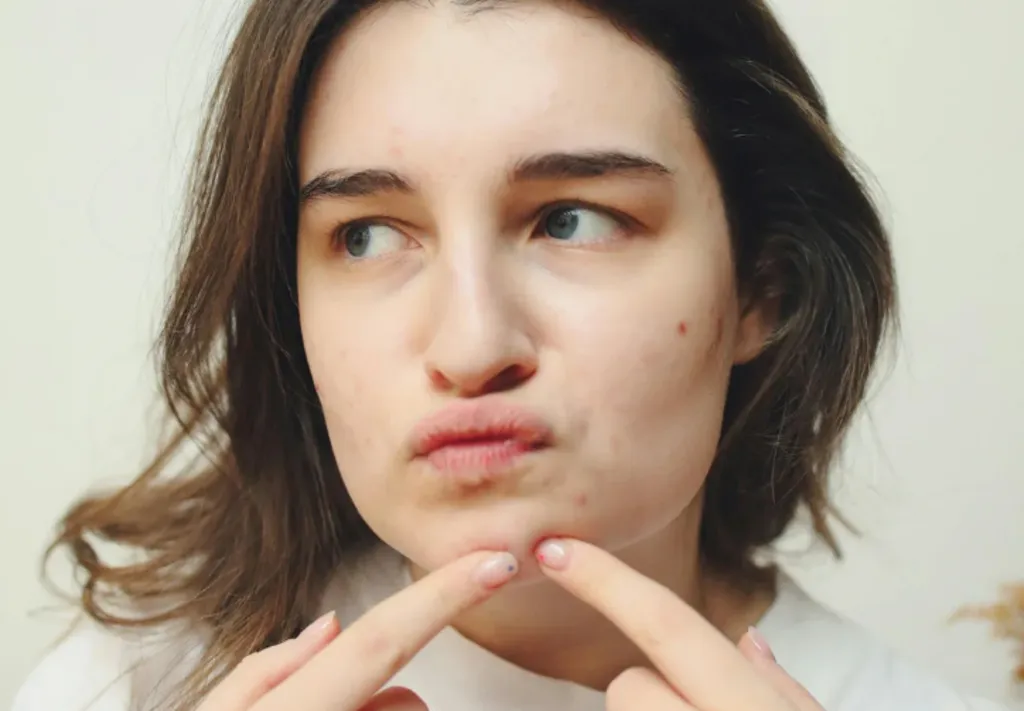 Crescimento de acne entre mulheres acende alerta para impactos na saúde emocional